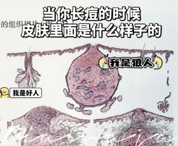 皮肤爆痘留印又留坑的真相